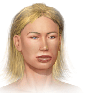 Angioedema-differential diagnosis – emblogs.org