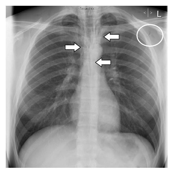 Pneumomediastinum- evaluation and management – emblogs.org